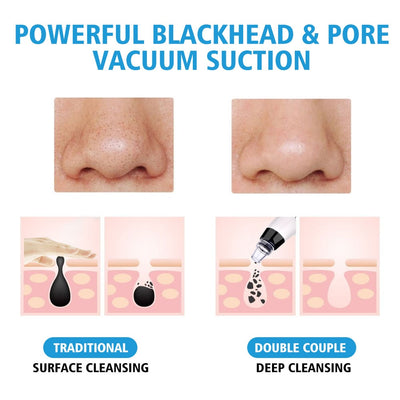 Blackhead Remover Vacuum Suction